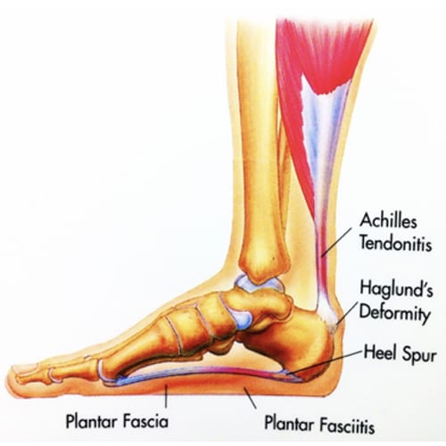 Posterior Heel Spur Diagnosed & Treated by Foot Surgeons - Mercy