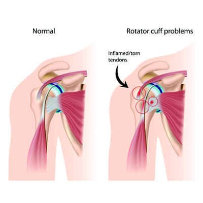 Rotator Cuff Tears: You can get back to normal even with a full