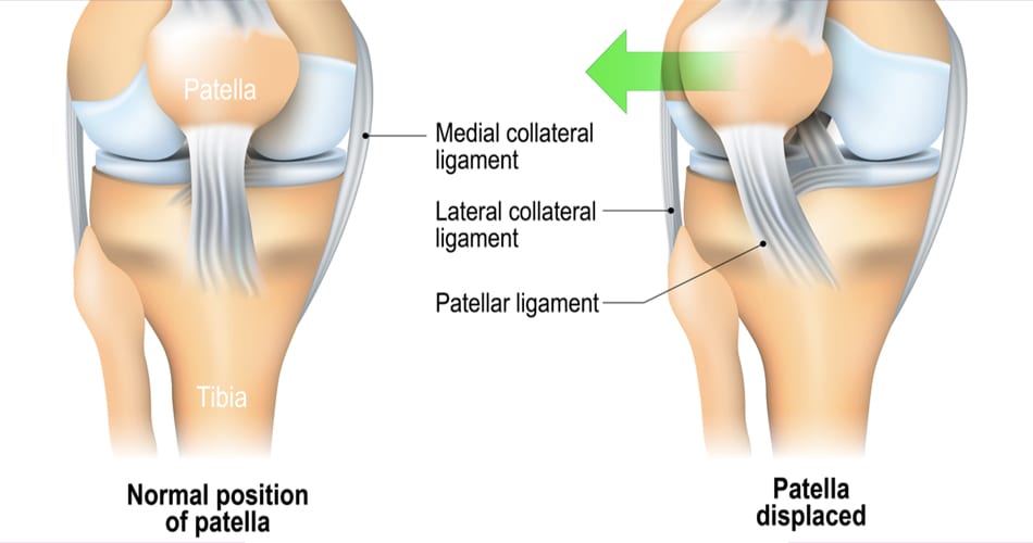 treating knee cap pain and subluxation