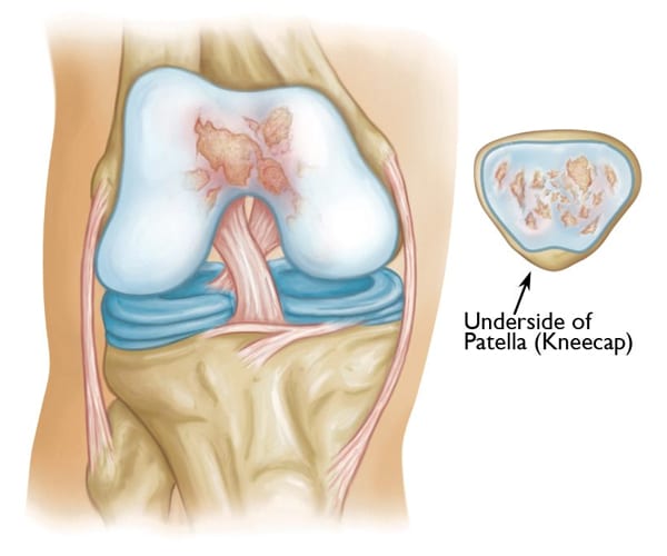 Patellofemoral Joint Disease