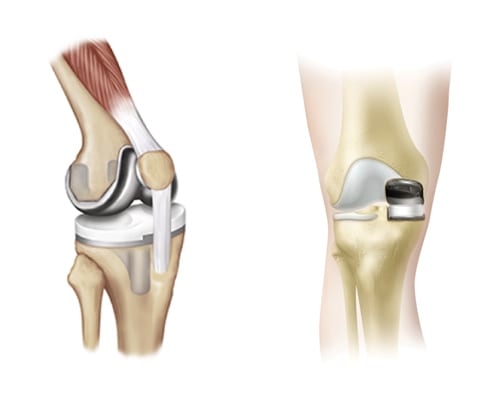 total knee replacement compared to partial knee replacement