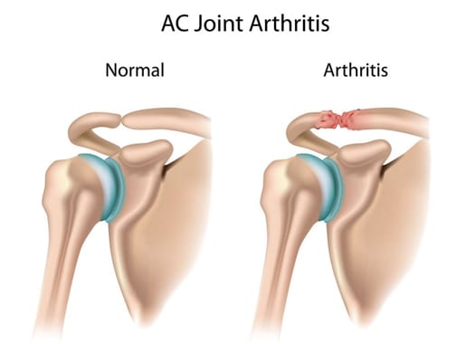 AC Joint Arthritis  Kenneth Bramlett, MD
